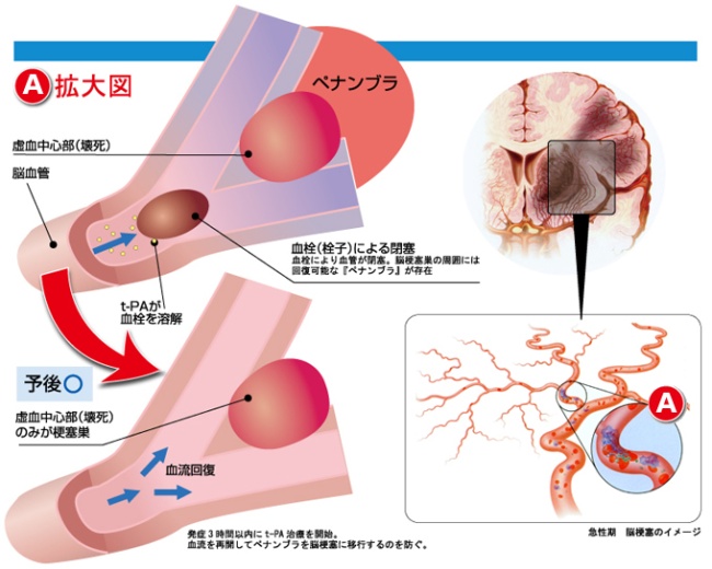 t-PAによる治療解説