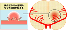 高血圧などが原因となって出血が起こる