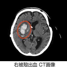 右被殻出血 CT画像