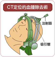 CT定位的血腫除去術
