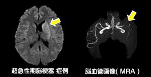 超急性期脳梗塞 症例/脳血管画像(MRA)