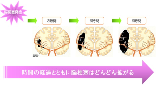 発症からの時間の経過とともに脳梗塞はどんどん拡がる