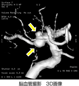 脳血管撮影 3D画像