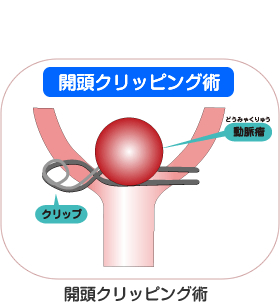 開頭クリッピング術