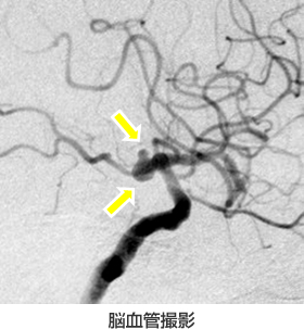 脳血管撮影