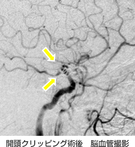 開頭クリッピング術後　脳血管撮影