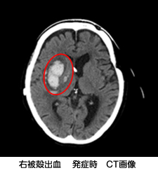 右被殻出血 発症時 CT画像