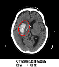 CT定位的血腫除去術直後 CT画像