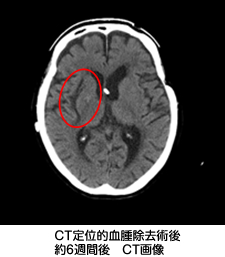 CT定位的血腫除去術後 約6週間後 CT画像