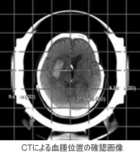 CTによる血腫位置の確認画像