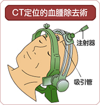 CT定位的血腫除去術